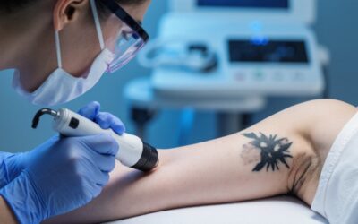 Tattooentfernung per Laser