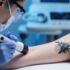 Tattooentfernung per Laser